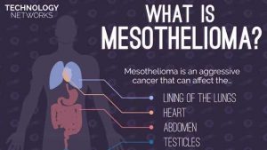 Chemo Plus Immunotherapy Shows Promise As First-line Treatment for Mesothelioma – Technology Networks