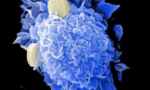 Immunotherapy with CAR T cells results in exceptional patient recovery – Medical Xpress