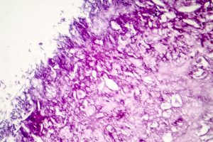 ctDNA May Be Reliable Predictor of Outcomes with First-Line Immunotherapy for Melanoma – Cancer Network